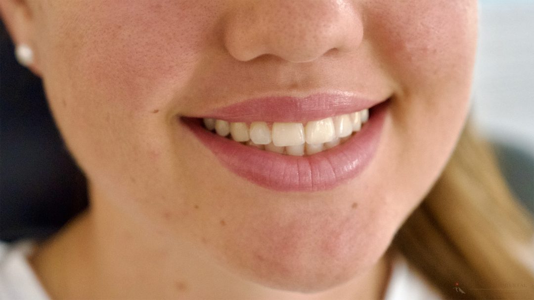 Teeth whitening by bleaching