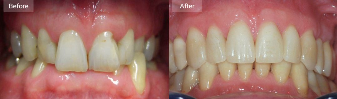 CMD therapy before and after comparison