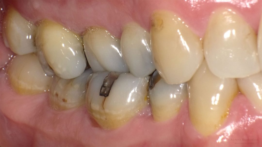 Dentures with amalgam fillings