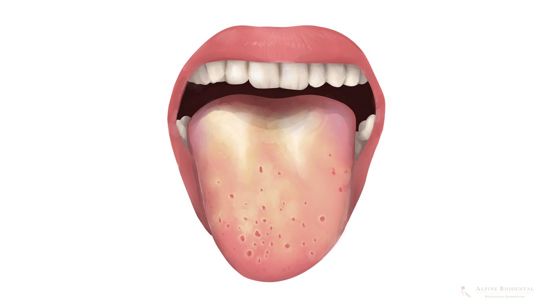 Candida / oral thrush