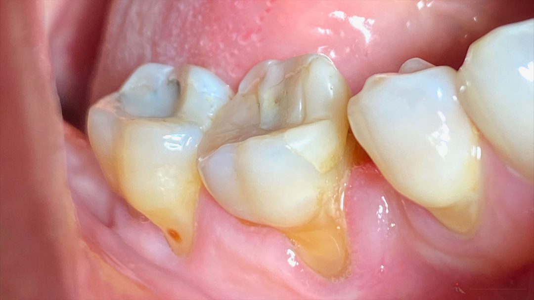 Zahnfleischrückgang an den Backenzähnen