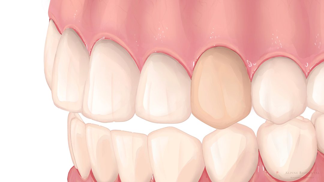 Tooth discoloration